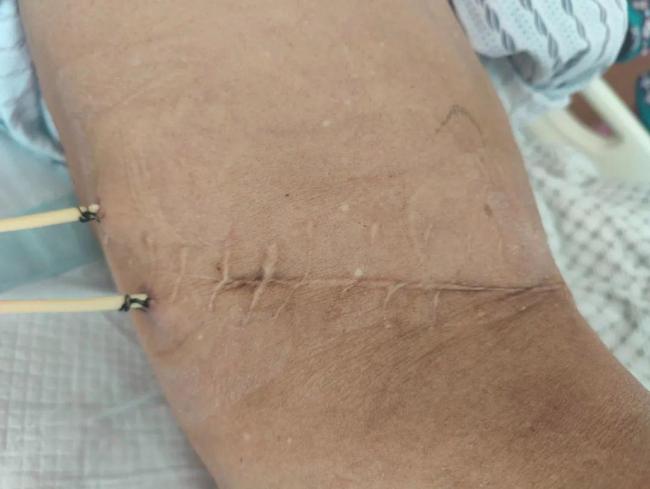 男子体内发现1791颗结石 结石王国惊现肾脏